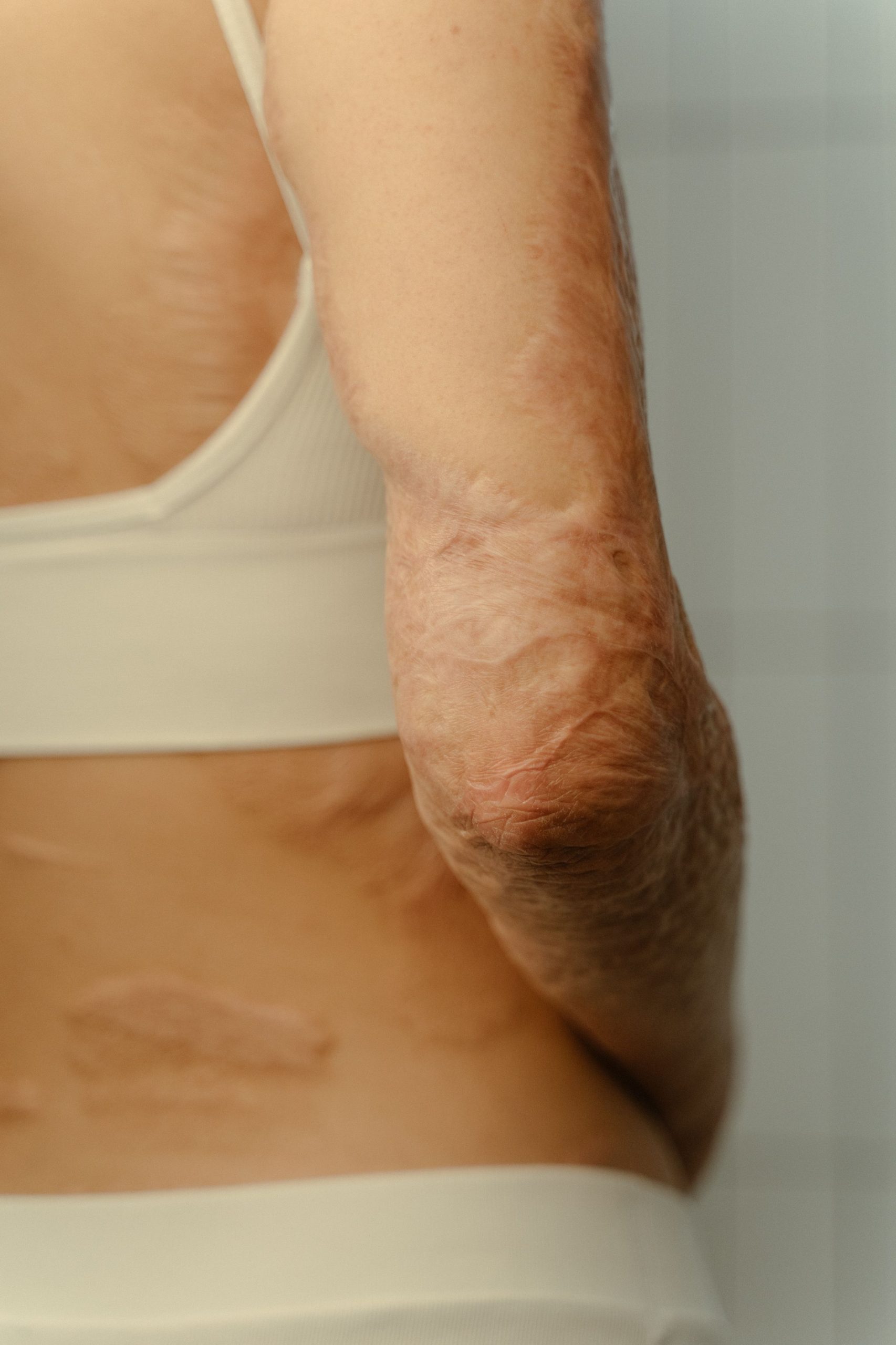 Gros plan détaillé sur un bras montrant des cicatrices de brûlure, mettant en évidence la texture de la peau et le processus de cicatrisation.